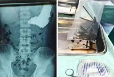 Slamet ODGJ Indramayu Hobi Makan Tak Biasa, Saat Operasi Ditemukan 70 Batang Paku Nyangkut di Perut