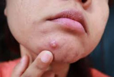 Jerawat di Dagu Bikin Minder? Simak Tips Ampuh Atasinya di Sini!