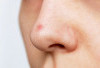 Hidung Berjerawat? Ini 7 Cara Efektif yang Bisa Kamu Coba di Rumah