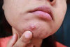 Jerawat di Dagu Bikin Minder? Simak Tips Ampuh Atasinya di Sini!